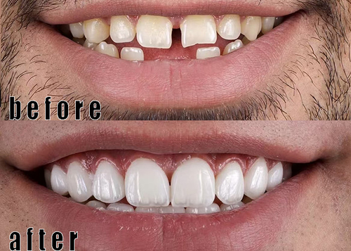 Porcelain Veneers case 3