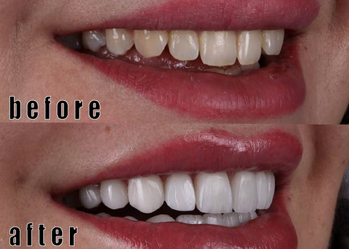 Glass-Ceramic Veneers case 4