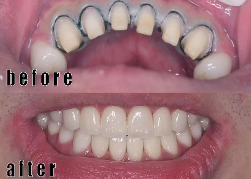 zirconia crown