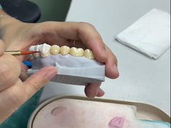 Translucent Ceramic Crowns for Dental Restoration with Natural Aesthetics and Easy Cleaning