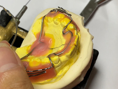 Custom Made orthodontic appliance with Good Retention and Adjustable Features