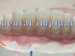 Titanium Dental Implant Crowns And Bridge For Tooth Restoration And Replacement