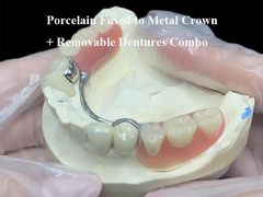 Porcelain Fused To Metal Crown plus cast partial removable dentures combo