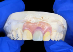 Nesbit partial denture for incisors offering a seamless removable tooth replacement solution