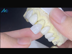 IPS Emax Veneers Minimal Prep/ No-prep Veneers Are Innovative Solutions For Beautiful Smile