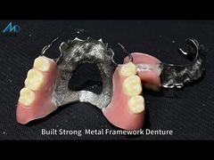 Watch: Titantium Cast Partial Dentures With Clasps Rests Along With Teeth Set Up Showcase