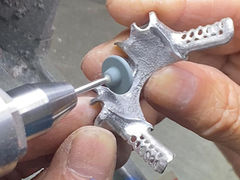 Cast Partial Denture