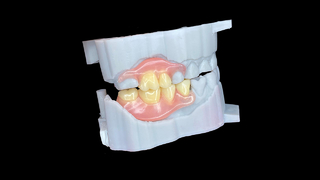 Custom Flexible Dentures with a natural fit and lasting comfort.