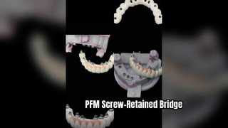 Precision PFM Screw-Retained Implant Restoration