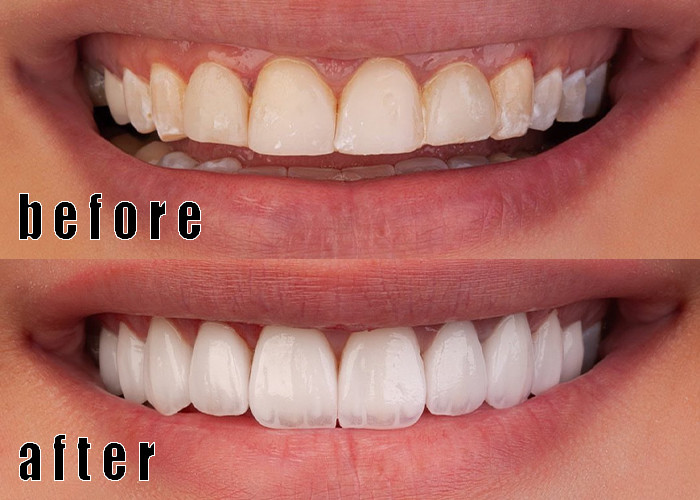 Latest company Cases about emax veneer case 1