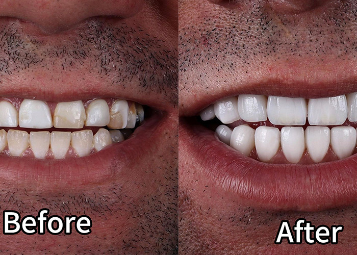 Latest company Cases about emax veneer case 2