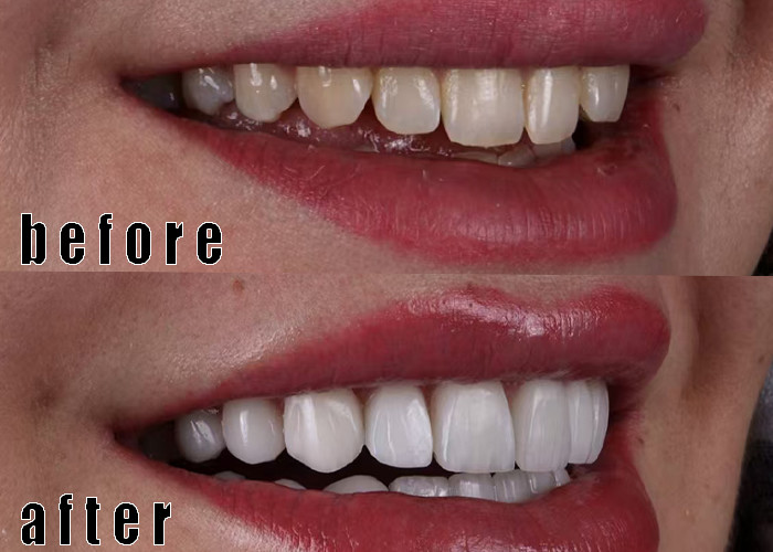 Latest company Cases about Glass-Ceramic Veneers case 4