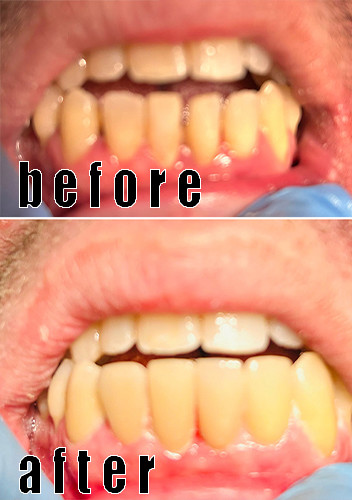 Latest company Cases about The Emax veneer was used to close the open bite