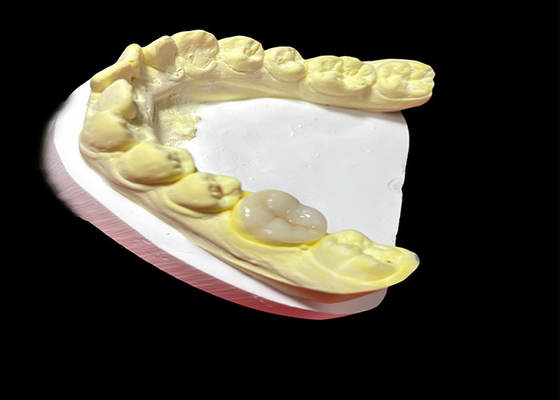 Buy High-Quality Ceramic Inlays and Onlays for Seamless and Long-Lasting Tooth Restoration online manufacture