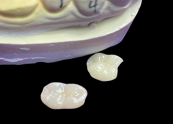 Buy IPS e.max Ceramic Inlays and Onlays for Molar Restoration Natural Aesthetic and Superior Durability for Long-Lasting Results online manufacture