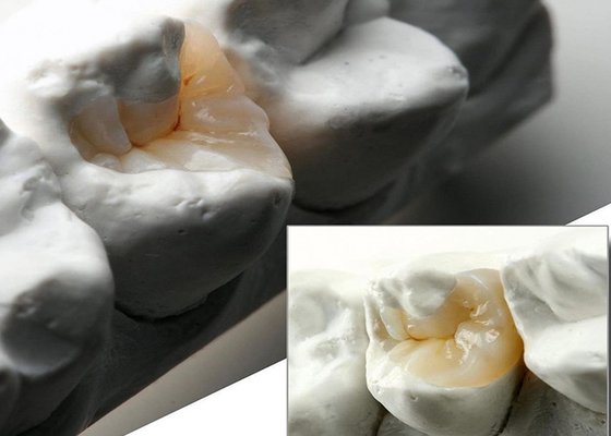 Buy Natural Looking Ceramic Inlays and Onlays for Precise Dental Restoration from Our Expert Dental Lab online manufacture