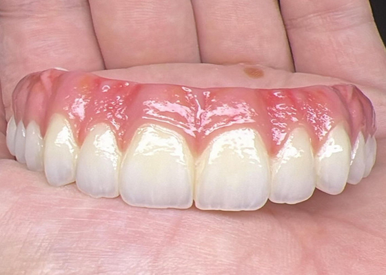 Buy Oral Health Dental Implant Supported dentures Bridge Polished Surface Supporting Full Dentures online manufacture