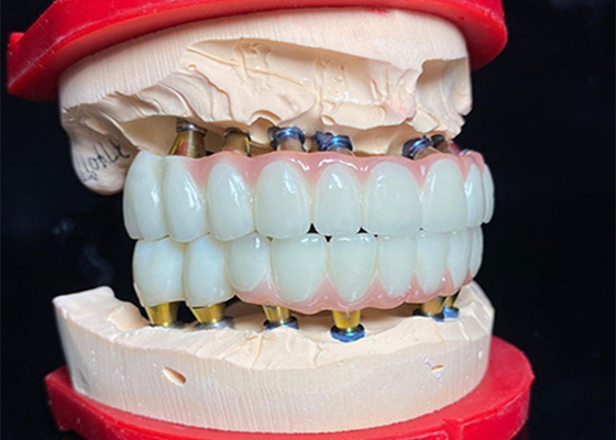 Buy Polished Titanium Base dental Implant Ceramic Crown Bridge For Dental Restoration online manufacture