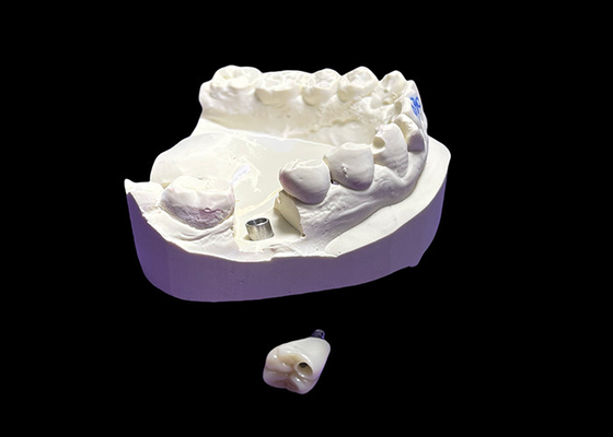 Buy Dental Implant with Ceramic Crown and titanium Abutment for molar online manufacture