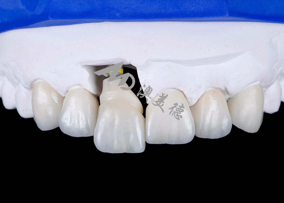 Buy Dental Implant Crown with Titanium Abutment For Natural Looking Smiles online manufacture