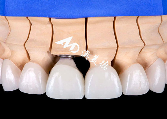 Good price Biocompatible Titanium Alloy Base Dental Implant Crown Bridge with Natural-Looking Aesthetic online