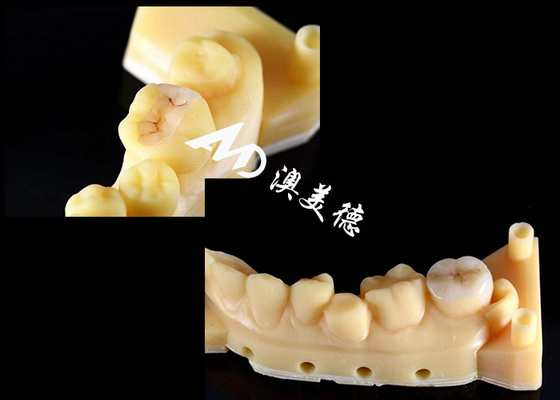 Buy Precision Ceramic Inlays and Onlays for Teeth Repair with Natural Color Hypoallergenic Material and Seamless Fit for Superior Comfort and Durability online manufacture