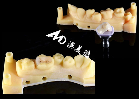 Buy Smooth Hypoallergenic Ceramic Inlays Onlays Custom Fit Stain Resistance High Durability online manufacture