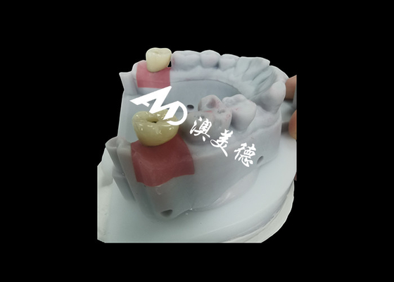 Buy Dental Implant Crown with titanium abutment for Durable Tooth Restoration online manufacture