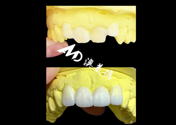 Buy Custom Translucent Zirconia dental Crowns Crafted by AMD Dental Lab online manufacture