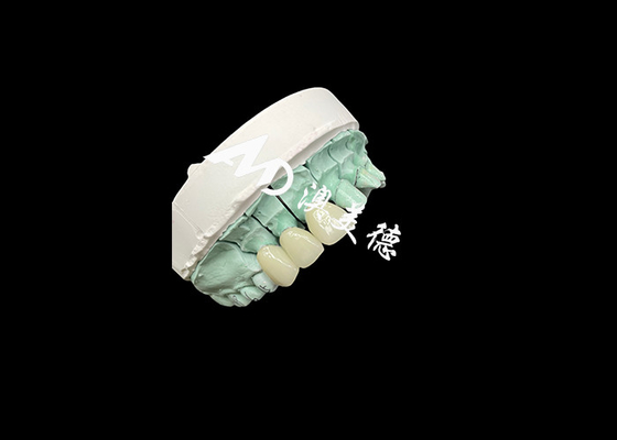 Buy Emax Ceramic Crown Customizable and Affordable Solution for Dental Restoration online manufacture