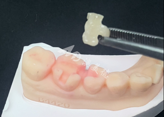 Buy Emax Ceramic Inlays Onlays Dental Restorations For Natural Tooth Color And Easy Maintenance online manufacture