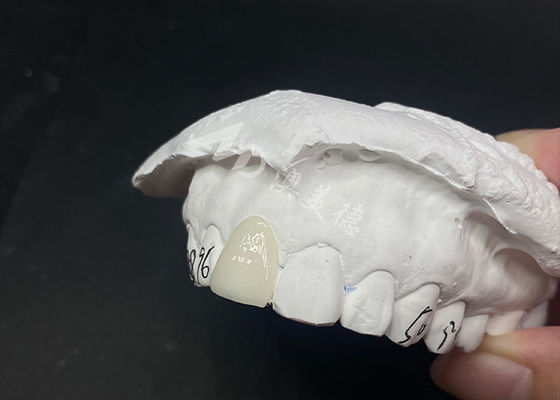 Good price Translucent Custom Dental Veneers Fast and Effective Solutions for Long-Lasting Smile online