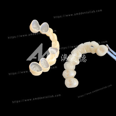 Buy Excellent Biocompatibility Porcelain Fused To Metal Crown Secure Bonding Natural Looking Aesthetic Durable Dental Crown online manufacture