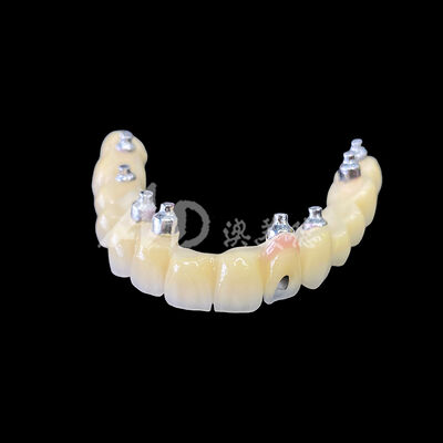 Good price Porcelain-Fused-to-Metal (PFM) Screw-Retained Implant Bridge online