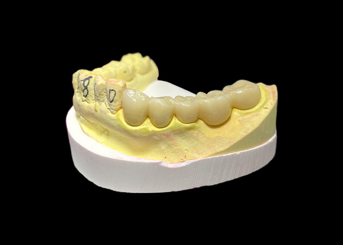 Premium Zirconia Porcelain Dental Crown Unmatched Strength Precision Fit and Exceptional Aesthetics and Durability