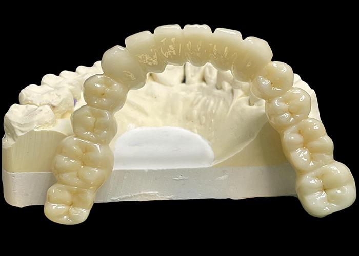 Vita Classical Shade All Ceramic Crown Bridge Natural Looking For Dental Restoration