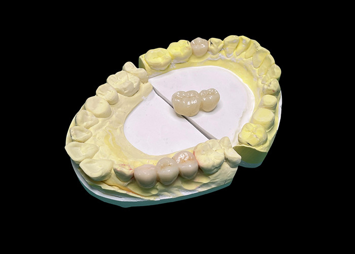 Advanced Translucency Ceramic Crowns and Bridges Enhance Your Smile with Precision and Natural Aesthetics for Long-lasting Durability