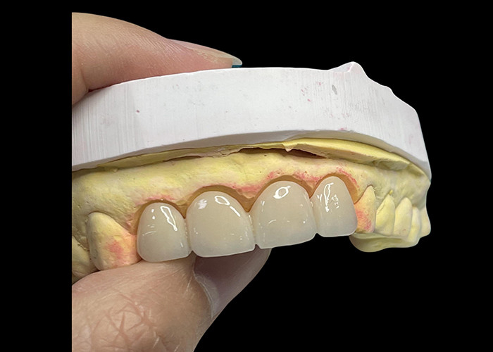 Advanced Translucency Ceramic Crowns and Bridges Enhance Your Smile with Precision and Natural Aesthetics for Long-lasting Durability