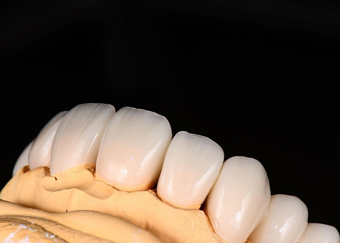 Advanced Translucency Ceramic Crowns and Bridges Enhance Your Smile with Precision and Natural Aesthetics for Long-lasting Durability