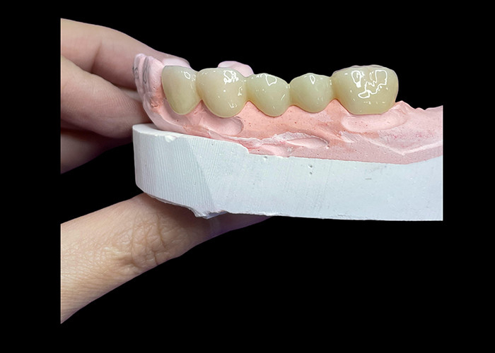 All Ceramic Crowns and Bridges Designed for Superior Aesthetics Durability and Natural Fit for Long-Lasting Confidence