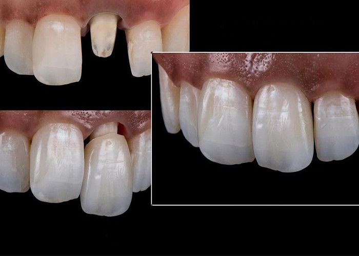 All Ceramic Crowns and Bridges Designed for Superior Aesthetics Durability and Natural Fit for Long-Lasting Confidence