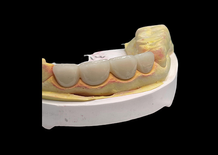Long lasting Wear resistant Strength all Ceramic Crown Bridge with Excellent Biocompatibility for dental restoration