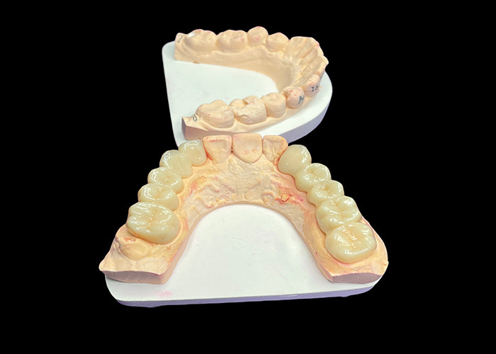 Natural Aesthetics Translucent Ceramic Crowns for Dental Restoration with Easy Cleaning and Long-Lasting Results
