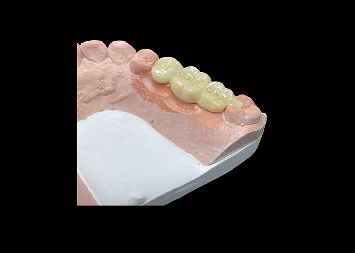 Natural Aesthetics Translucent Ceramic Crowns for Dental Restoration with Easy Cleaning and Long-Lasting Results