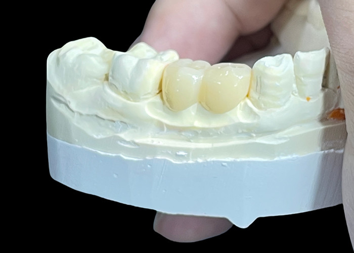 Durable Wear Resistant Customized All Ceramic Crowns and Bridges for Perfect Fit and Long Lasting Performance