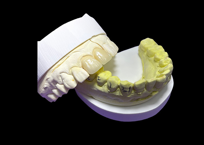 Durable Wear Resistant Customized All Ceramic Crowns and Bridges for Perfect Fit and Long Lasting Performance