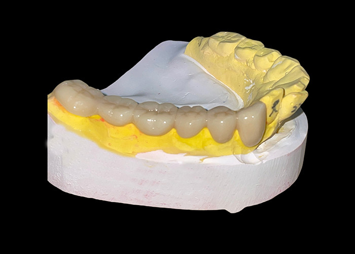 Durable Wear Resistant Customized All Ceramic Crowns and Bridges for Perfect Fit and Long Lasting Performance