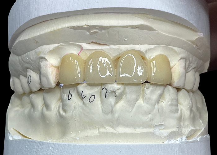 Stain Resistant All Porcelain Bridge Comfortable Fit For Dental Restoration