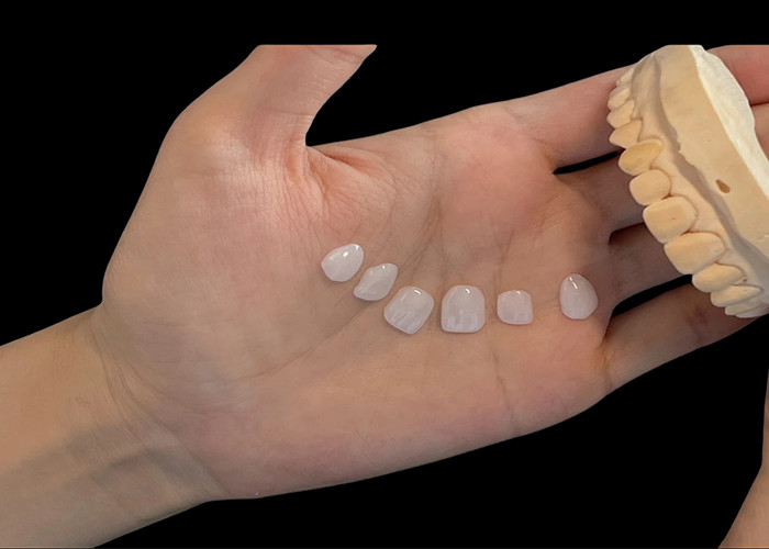 Porcelain Shade Ultra Thin EMAX Veneers Stain Resistant For Aesthetic Restorations