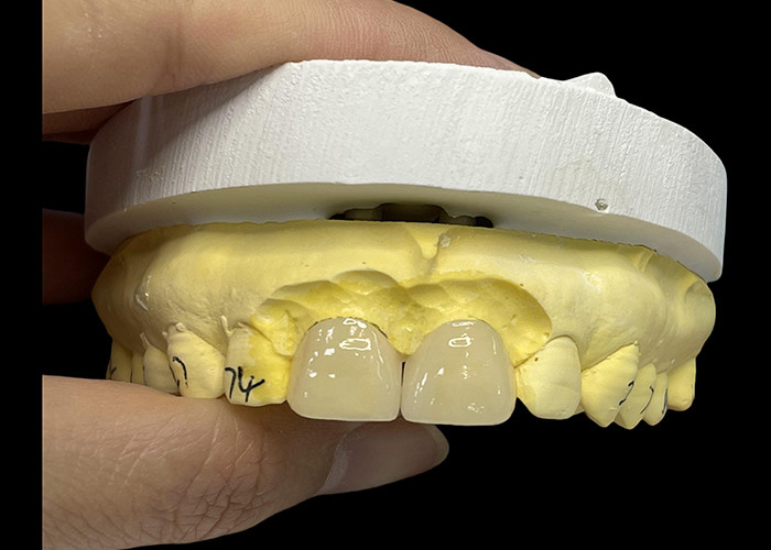 Porcelain Shade Ultra Thin EMAX Veneers Stain Resistant For Aesthetic Restorations